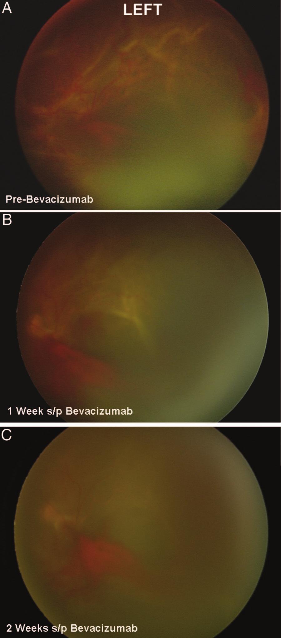 vitreous hemorrhage rapidly resorbed revealing regressing retinal neovascularization.