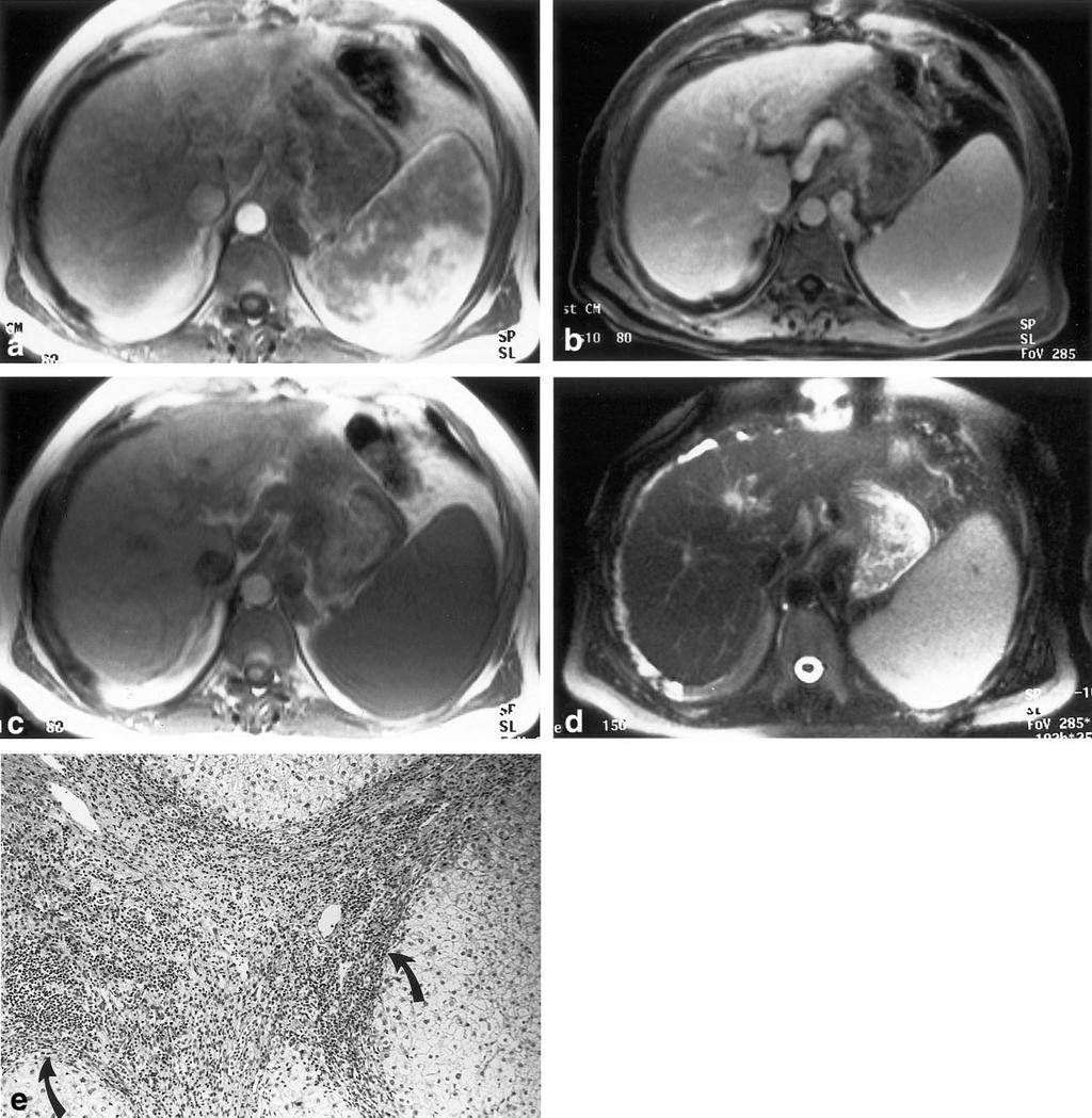 244 Kanematsu et al. Figure 1. MR images in a 62-year-old man with cirrhosis of the liver associated with chronic type C viral hepatitis.