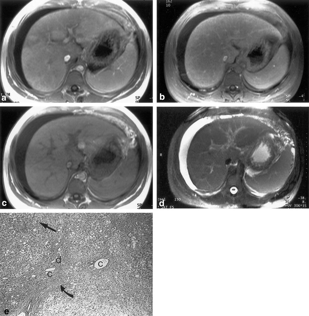 246 Kanematsu et al. Figure 3. MR images in a 24-year-old woman with chronic liver damage due to Wilson s disease.
