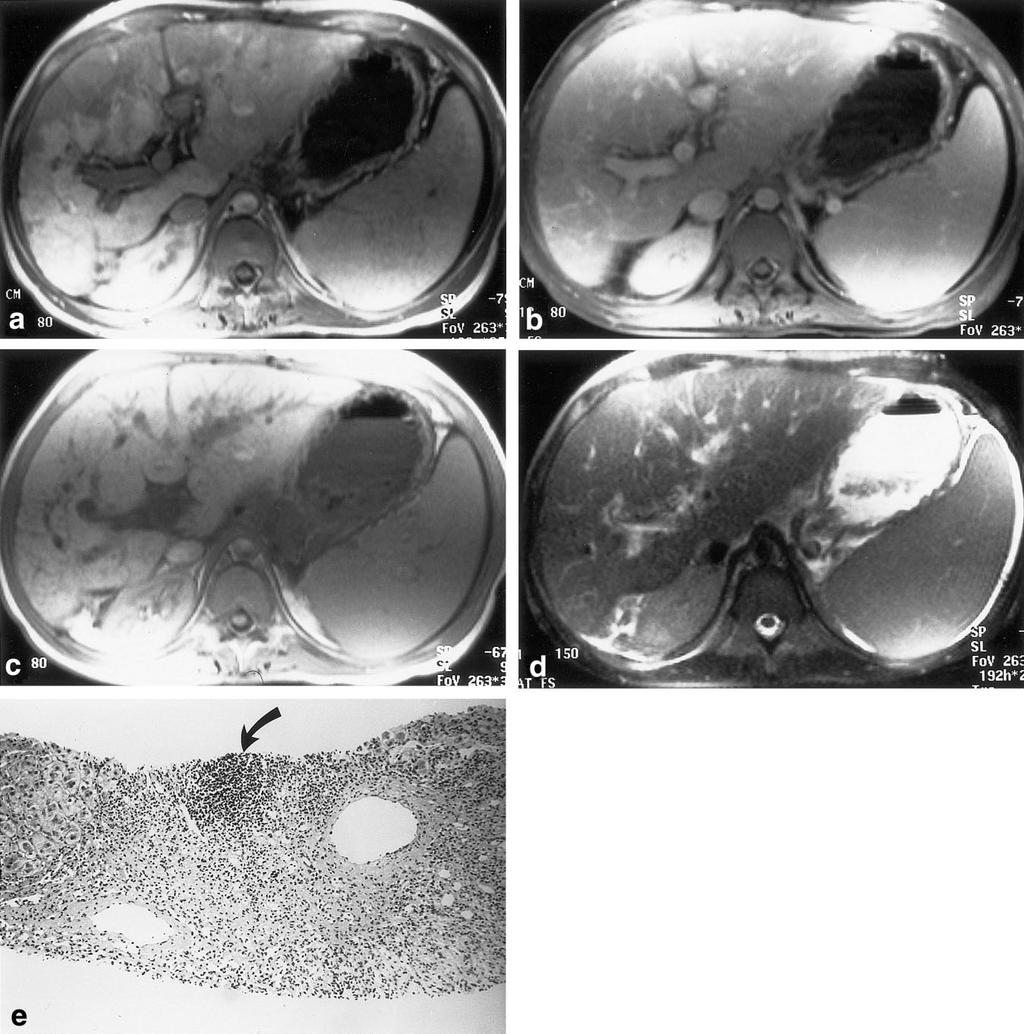 Early Heterogeneous Enhancement in Liver MRI 247 Figure 4. MR images in a 25-year-old man with allograft rejection 10 years after orthotopic liver transplantation for autoimmune hepatitis.
