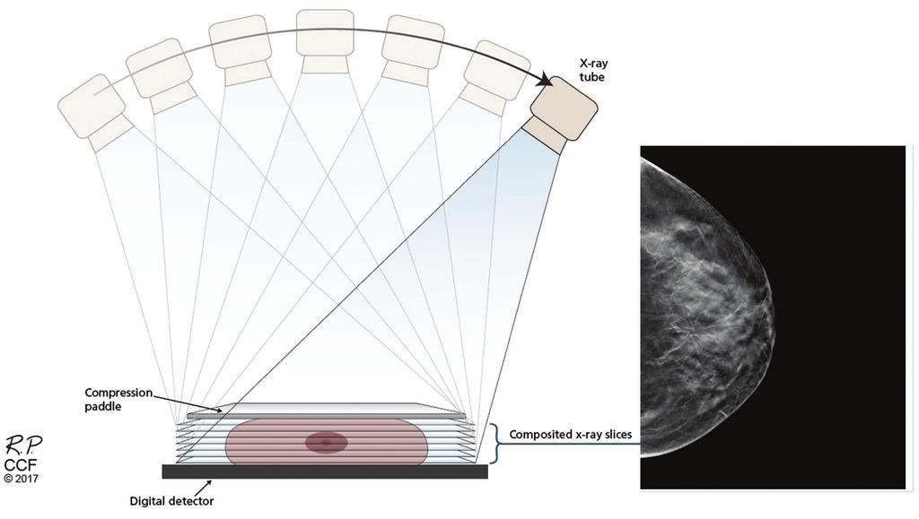 TAKAHASHI AND COLLEAGUES FIGURE 1. Schematic representation of image acquisition with breast tomosynthesis. fewer false-positive results.