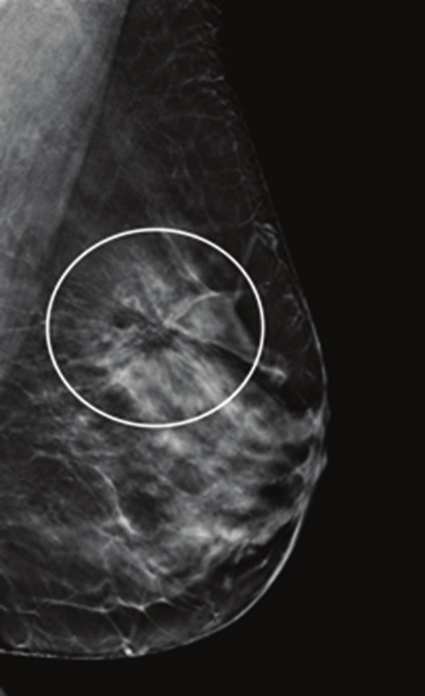 MAMMOGRAPHY A B No national organization currently recommends DBT for primary breast cancer screening FIGURE 2.