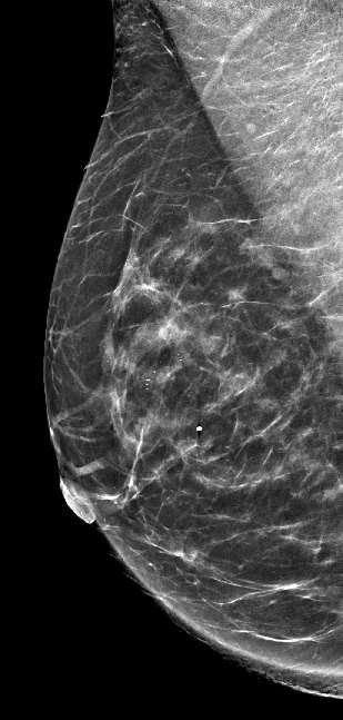 Standard Mammogram