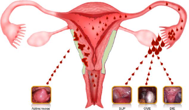 Implantation theory of endometriosis Adenomyosis SUP OMA DIE SUP,