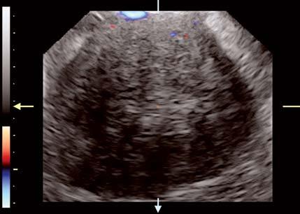6: Transvaginal ultrasound that shows pelvic carcinomatosis, a tumoral plaque is seen involving the bladder peritoneum Fig.