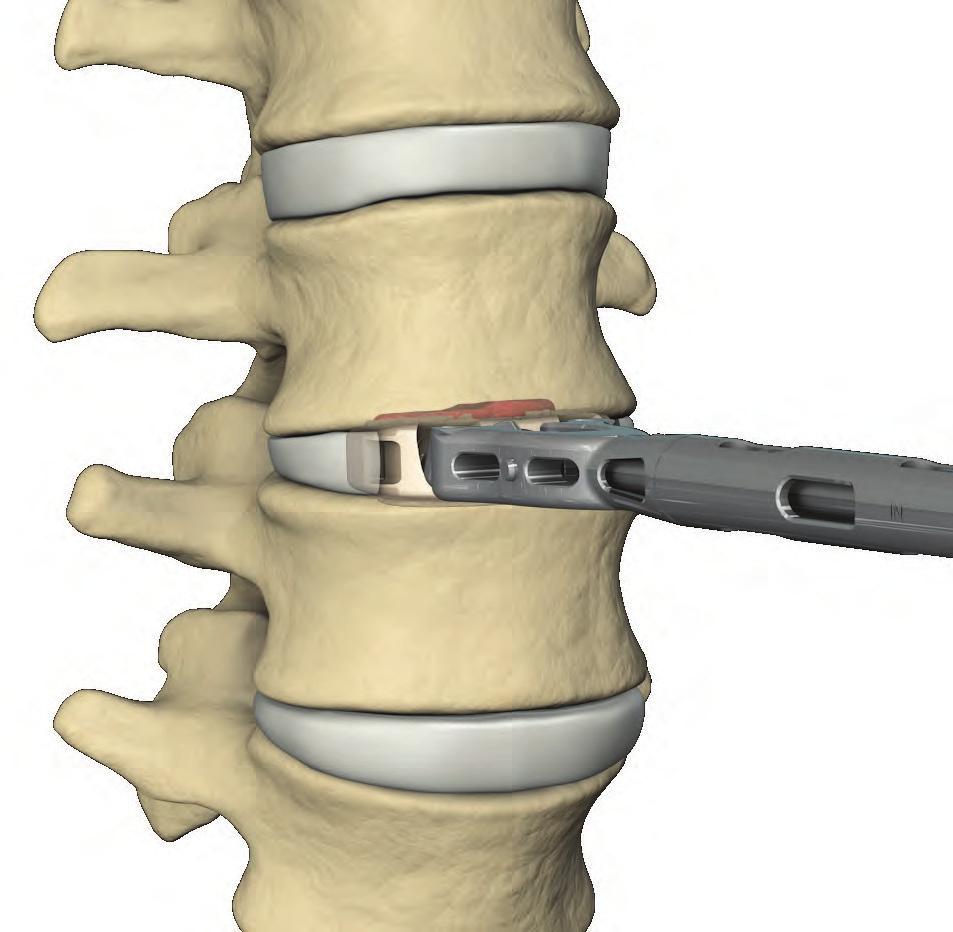 The device is positioned flush or up to 1mm anterior to