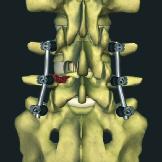 Implant Compression Insert rods into pedicle screw construct, completing