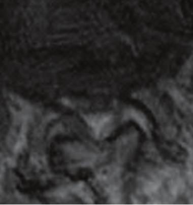 (c) Myelogram obtained in a head-lowering prone position showing obstruction at the L3 vertebra level. a sequential mass was observed from the L2/3 disc to the L3 vertebral body level.