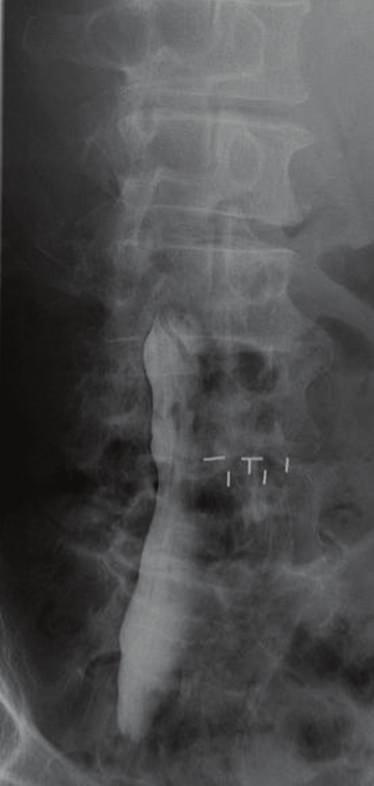 Discussion Proximal adjacent segment degeneration or disc degeneration after instrumented spinal fusion has been widely reported [6 8].