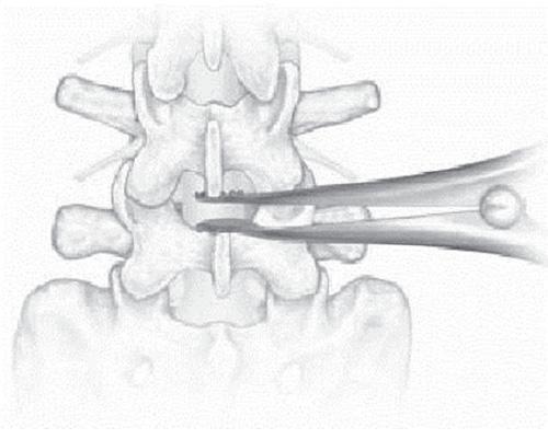 1 DISTRACTION Parallel distraction of the disc provides easier insertion of modules and ensures sufficient device height Distraction can be applied between pedicle screw heads using a lateral