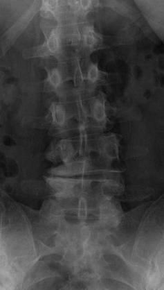 Case Example 3 Degenerative Disc Disease 49 y/o female CC: 7 MO LBP after work