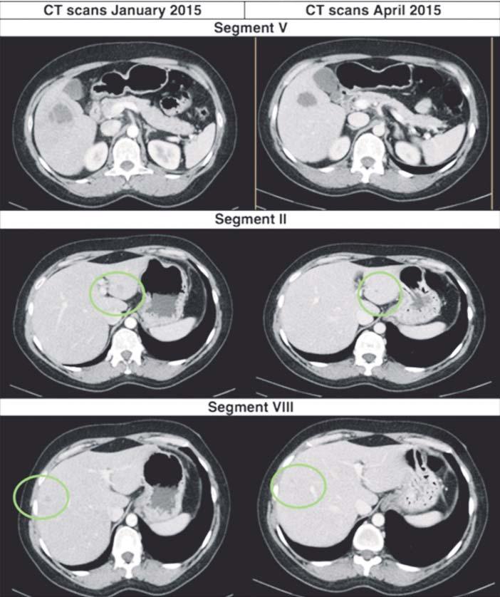 The breast tumor appearance at mammography (*) (A) and computed tomography (white