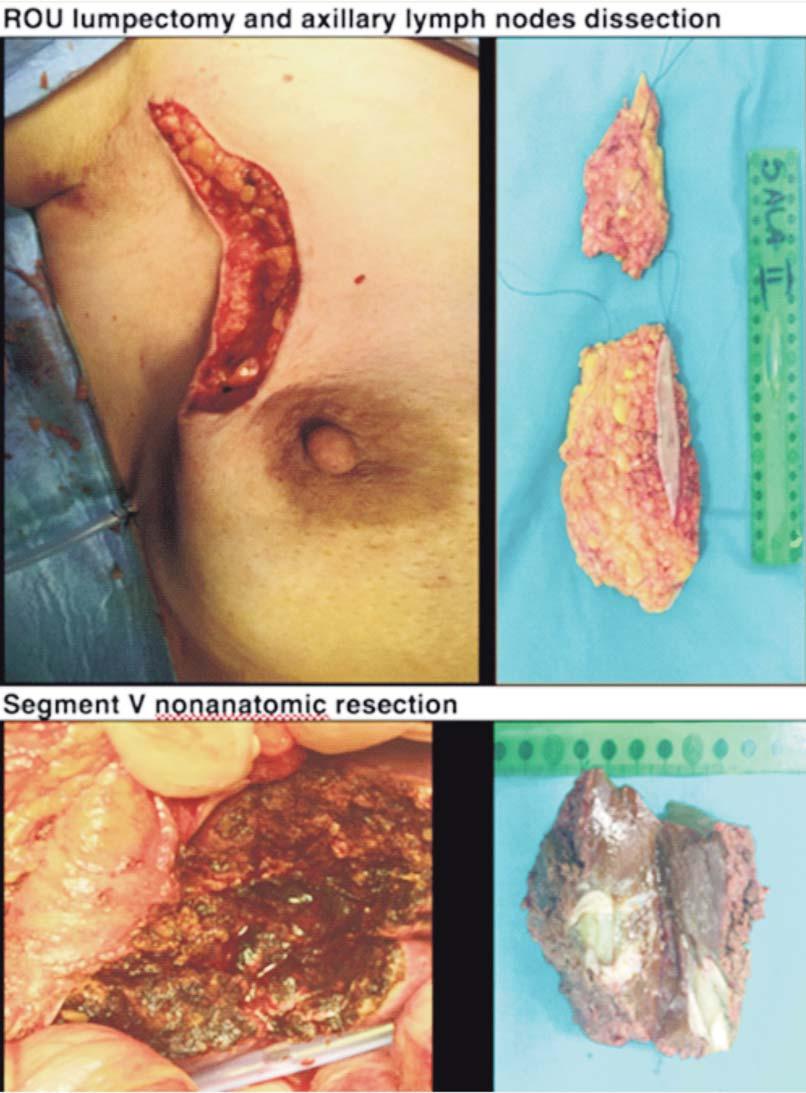 Simultaneous Breast and Liver Surgery in a Patient with Stage IV Triple Positive Breast Cancer A Case Report Figure 5.