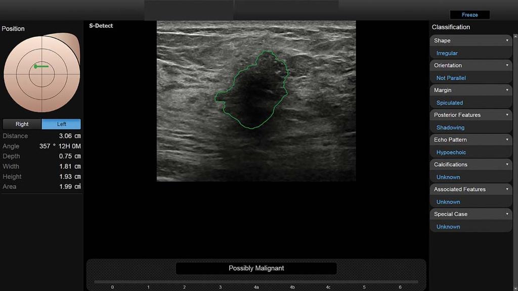 After image review by the radiologists, S-Detect was applied to the same image the radiologists used for grayscale ultrasonographic feature analysis.