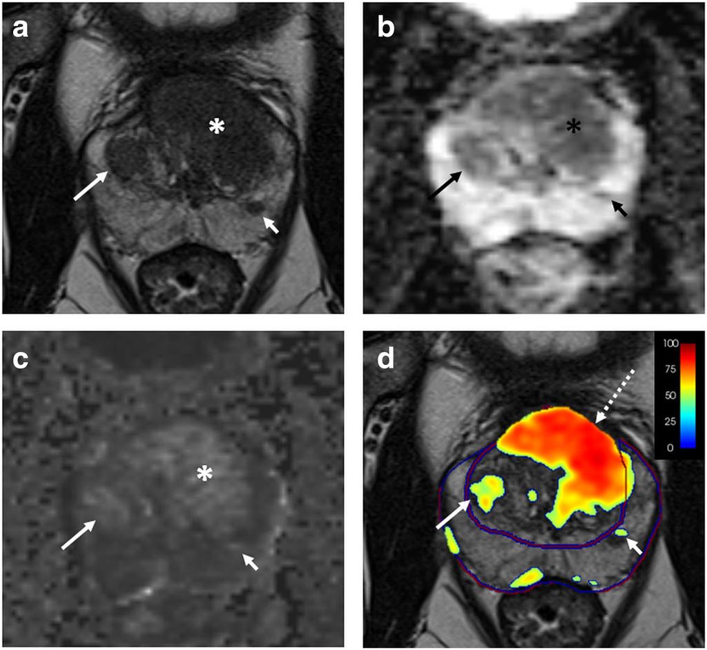 Girometti et al. European Radiology Experimental (2019) 3:5 Page 9 of 14 extraprostatic extension of PZ cancers [45].