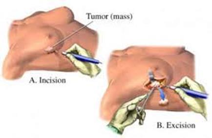 Prior surgery within the same quadrant as the mass to be biopsied.
