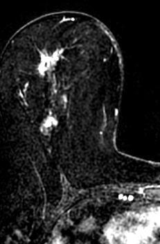 Routine clinical case MRI : Extension of an invasive lobular carcinoma Report Left breast: