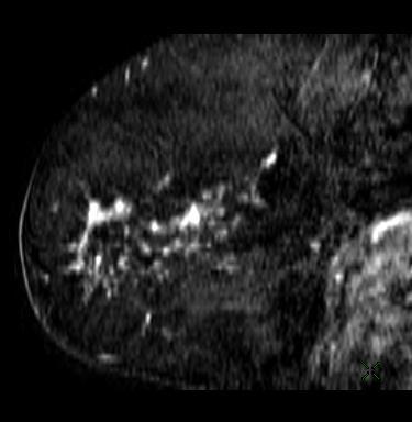BI-RADS 4c Strategy: Distance with index cancer : 4 cm 2 nd look ultrasound Percutaneous