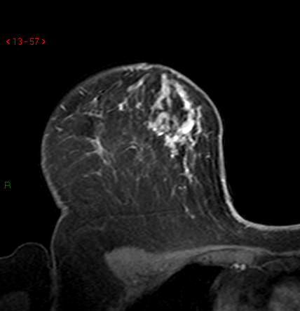 breast ultrasonography BI-RADS 3