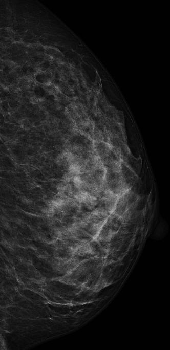 mammography and