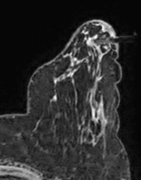 Axial T1 fat-suppressed early contrastenhanced subtracted MRI MR Biopsy - introductor in place History: 53 year old high-risk woman.