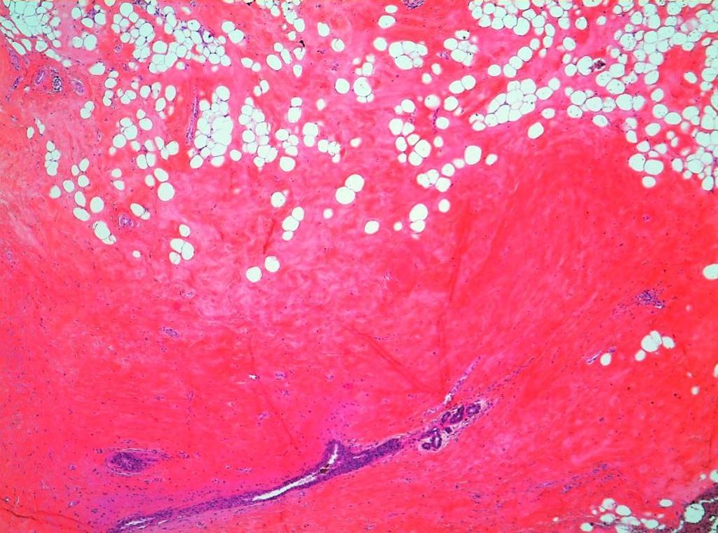 Pathology : Fibrosis Normal breast parenchyma with