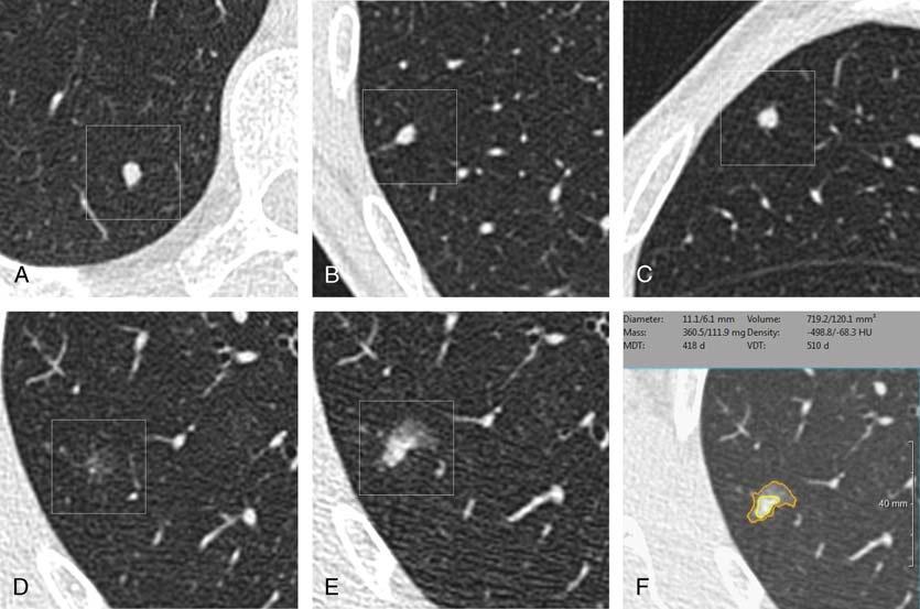 Investigative Radiology Volume 00, Number 00, Month 2018 CAD Improves Sensitivity for Subsolid Nodules TABLE 3.