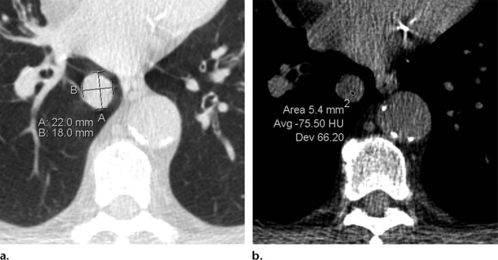 Clinical Example (a) Axial LCS chest CT image (lung window) in a 77-year-old man shows a solid nodule in the right lower lobe.