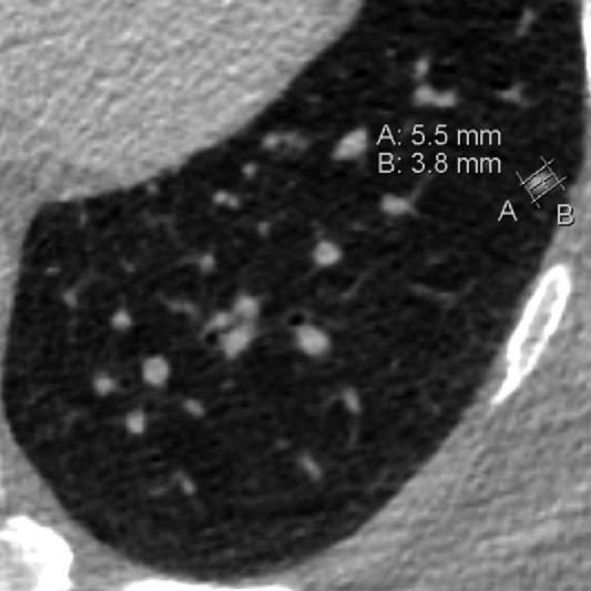 Clinical Example Axial LCS chest CT image (lung window) in a 59-year-old man shows a solid nodule in the left lower lobe.