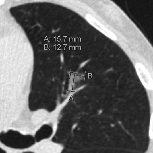 Clinical Example Axial LCS chest CT image (lung window) in a 61-year-old man shows a lingular nonsolid (ground-glass) nodule.
