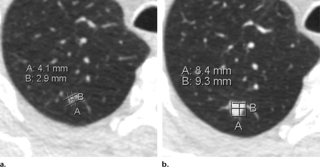 Clinical Example Axial LCS chest CT images in a 66-year-old man. (a) Lung window image shows a solid nodule in the right upper lobe.