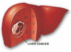 Risk factors for cirrhosis are Alcohol, Hepatitis B, Hepatitis C, diabetes and fatty liver. b) Secondary cancers?