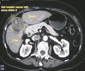 What is the incidence? GALL BLADDER CANCER?