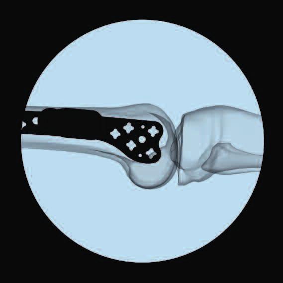 In larger patients, it is advan - tageous to attach the aiming arm after plate insertion as it could impinge upon the lateral soft tissues during insertion.