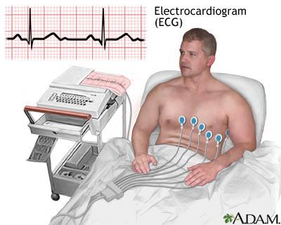 Electrical activity can be determined by EKG (electrocardiogra m) Electrodes