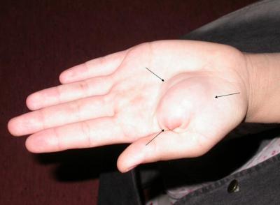 Figure 6 Figure 2b: Left palm, Neurofibroma (Arrows) Figure 7 Figure 2c: Right axilla (Dorsal plane) Cafe-au-lait spot previously reported in healthy children and young adults. Meyers et al.