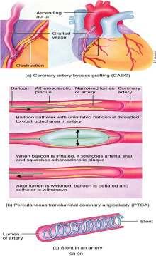 CAD Interventions CABG Coronary Artery Bypass Graft PTCA