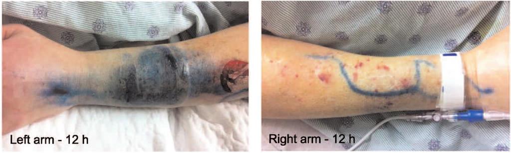Peripheral vasopressors in sepsis and cutaneous adverse events Duration infusion