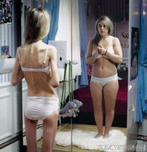 Anorexia Nervosa an eating disorder that involves an inability to stay at the minimum body weight considered healthy for the person's age and height (PubMed Health)