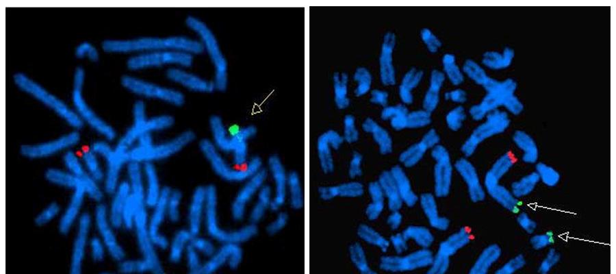 The 16p probe (green) hybridize to three chromosomes, two 16 and one chrom 1p(arrow),