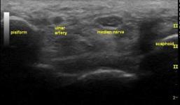 fat Peripheral Nerve Ultrasound