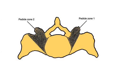 Figure 2. S1 pedicle zones 1 and 2. posteriorly (Figure 3).