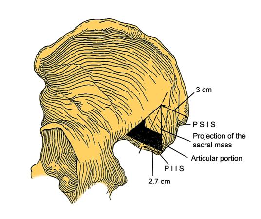 R. Xu et al Figure 4. Projection of lateral sacral mass on outer table of posterior ilium. Abbreviations: PSIS, posterior superior iliac spine; PIIS, posterior inferior iliac spine. hiatus.