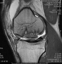 SUBCHONDRAL INSUFFICIENCY FRACTURE (spontaneous