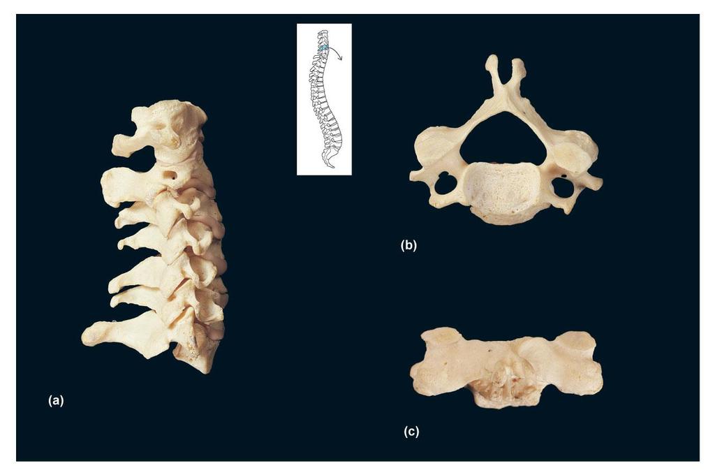 FIGURE 19A C C 5 Bifid spinous foramen Bifid spinous Superior Inferior Long spinous of C 7 right lateral view of articulated cervical vertebrae C 1 (atlas) C 2 (axis) C 3 C 4 C 5 C 6 C 7 (vertebra