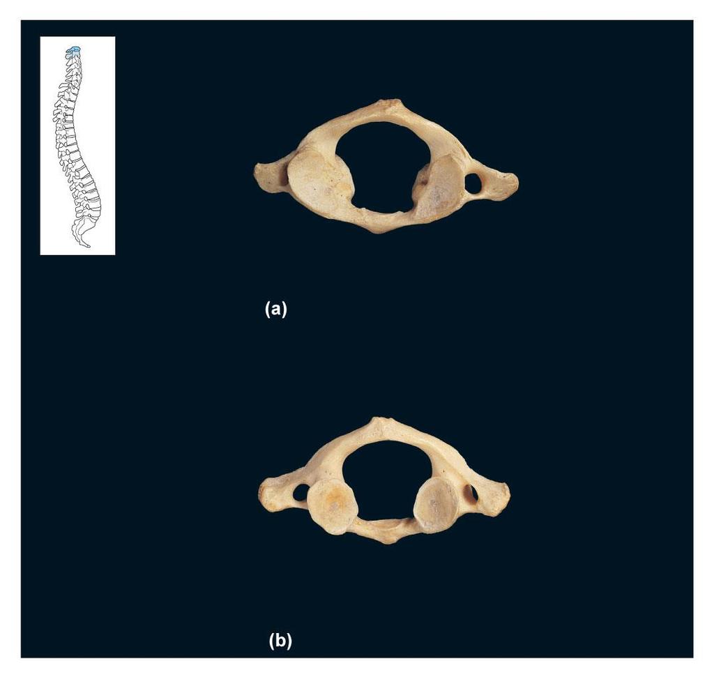 FIGURE 18A B C 1 C 2 Posterior tubercle Posterior arch Superior facet Anterior arch Lateral masses atlas, superior view Anterior tubercle foramen Posterior
