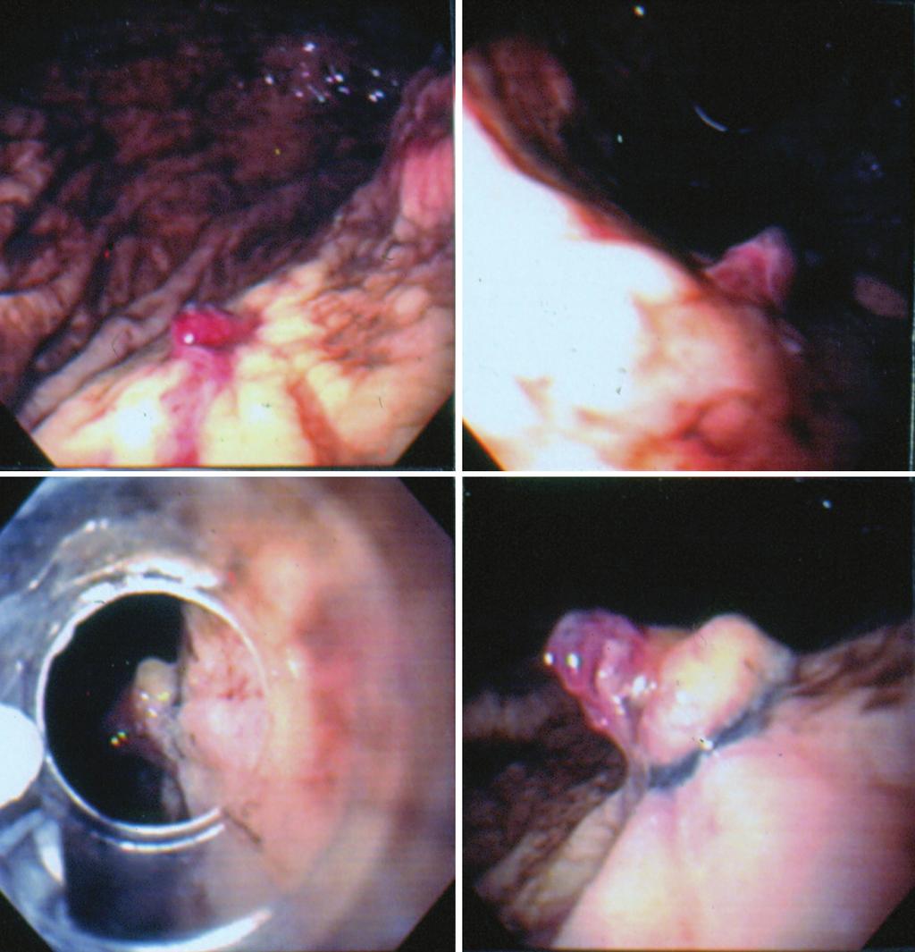 An upper endoscopy revealed a type 1 GAVE, and EBL of the ectasias was performed because APC was not available. Six bands were deployed from the stripes of the pylorus to a more proximal location.