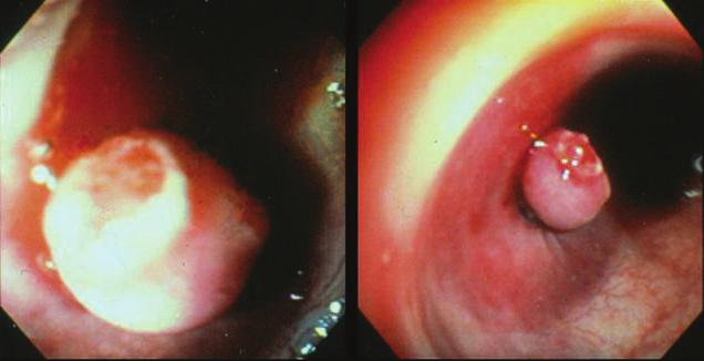 Figure 5) Stalk of polyp ligated with control of bleeding Figure 4) Spurting stalk after a polypectomy in the sigmoid colon Colonic diverticular bleeding has been reported to be effectively treated
