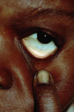 Iron Deficiency Anaemia Pale mucous