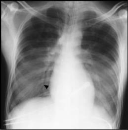 Consolidation Air bronchogram sign Viral acute pneumonia (mostly): Atypical (walking) Pneumonia,less symptoms (fever). Difficult to diagnose in routine culture studies, no need for Hospitalization.